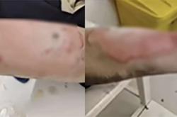 开云体育下载-罗马仕充电宝自燃致三度烧伤事故：非召回批次产品