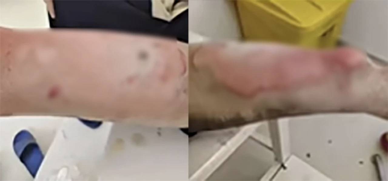 罗马仕充电宝自燃致三度烧伤事故：非召回批次产品